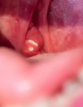 Amigdalitis Cirugía de Amígdalas en Cancún